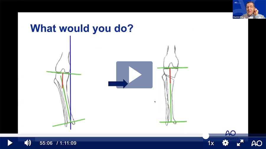 Medial Knee Arthritis
