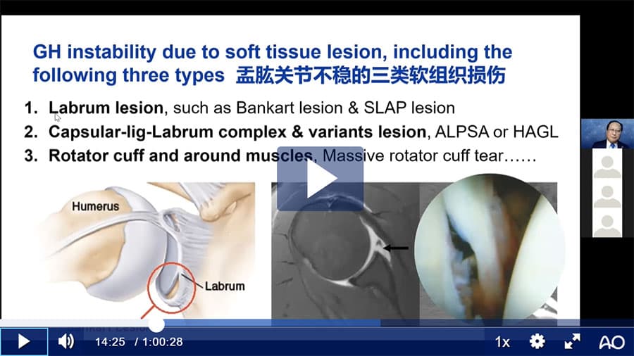 AO Sports Webinar—Arthroscopic Management of Glenohumeral Instability (Mandarin)