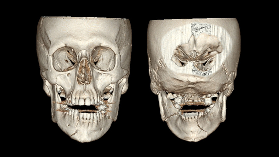 AO CMF North America: Management of Mandibular Fractures