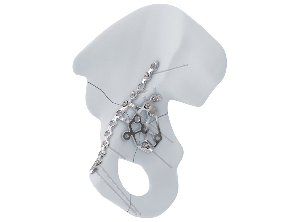 3.5 mm Intrapelvic Acetabular System