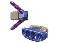 ChoiceSpine™ Announces Full Market Release of Next