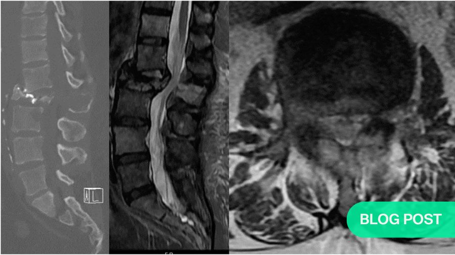 Molecular Prognostication in Spine Oncology: A Clinical Guide