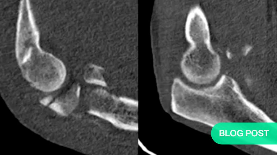 Subluxation after terrible triad fixation: key insights and